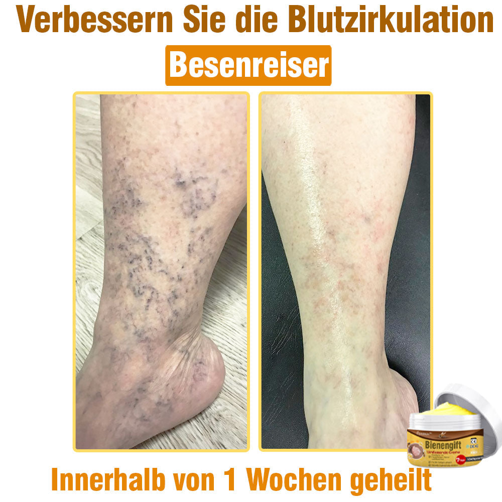 ⛑️ flysmus™ Bienengift Umfassende Creme 🇩🇪 Dermatologe empfohlen