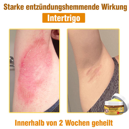 ⛑️ flysmus™ Bienengift Umfassende Creme 🇩🇪 Dermatologe empfohlen