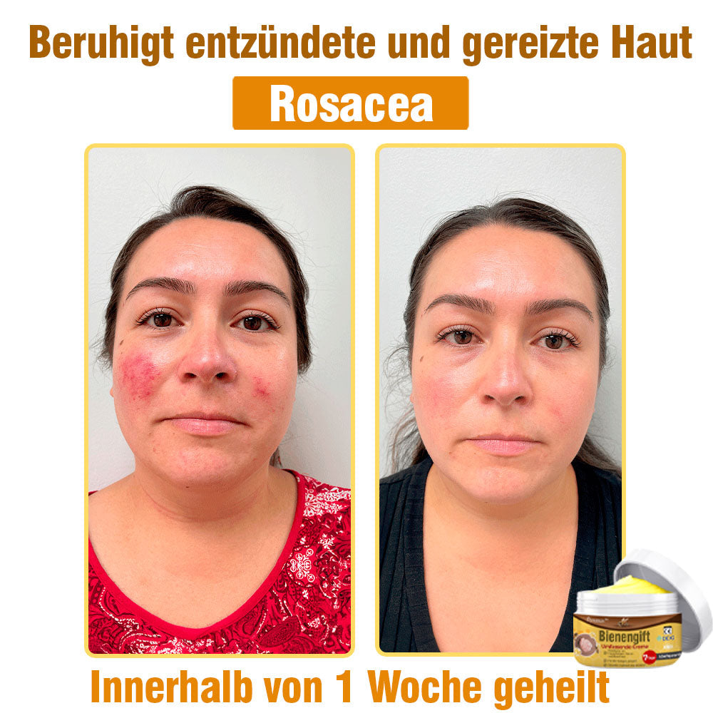 ⛑️ flysmus™ Bienengift Umfassende Creme 🇩🇪 Dermatologe empfohlen