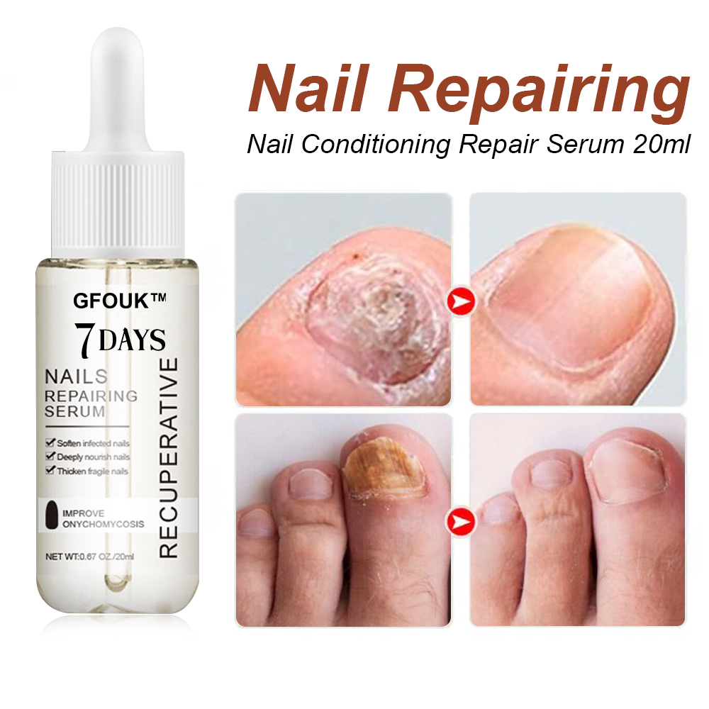 GFOUK™ 7-Tage Nagelwachstum und Stärkung der Nägel 🇩🇪 FDA-geprüft