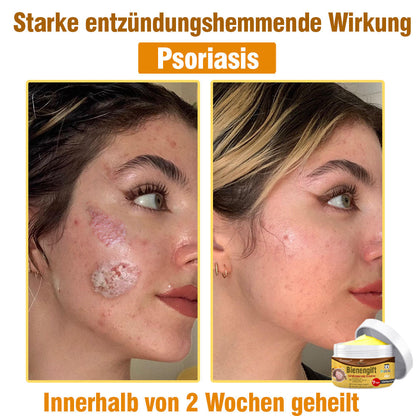 ⛑️ flysmus™ Bienengift Umfassende Creme 🇩🇪 Dermatologe empfohlen