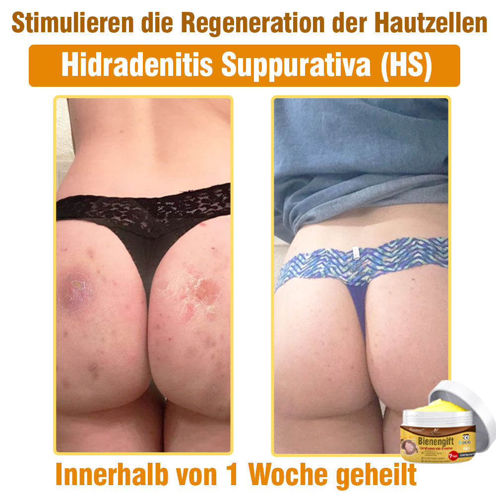 ⛑️ flysmus™ Bienengift Umfassende Creme 🇩🇪 Dermatologe empfohlen