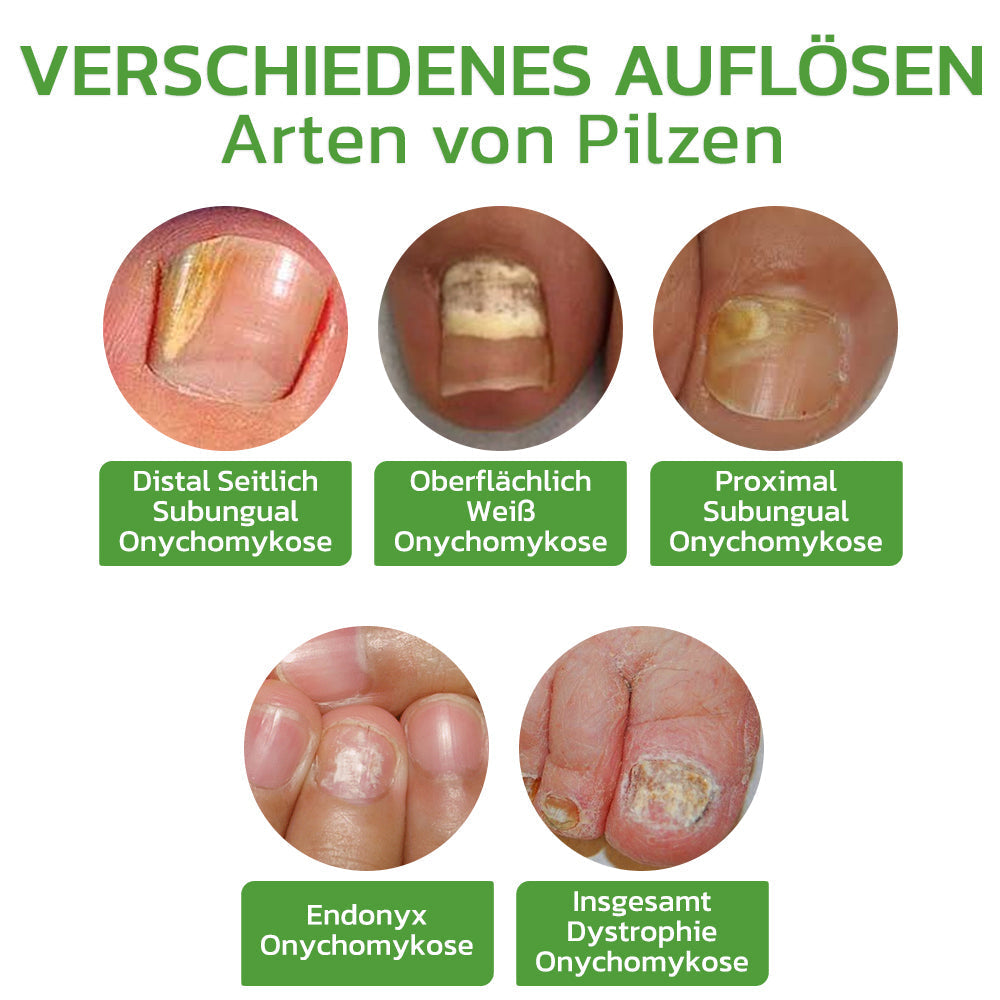 GFOUK™ 5 Tage Nagelwachstum und härtung Repair Roller