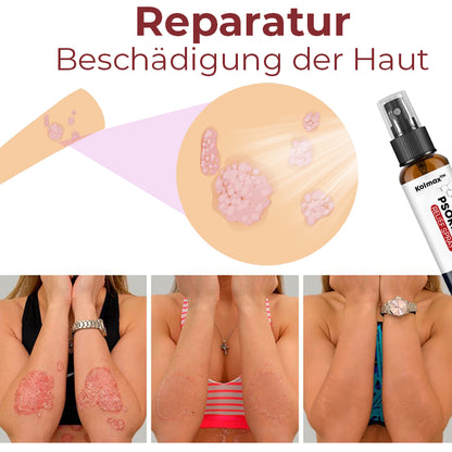 Kolmax™ Spray gegen Schuppenflechte