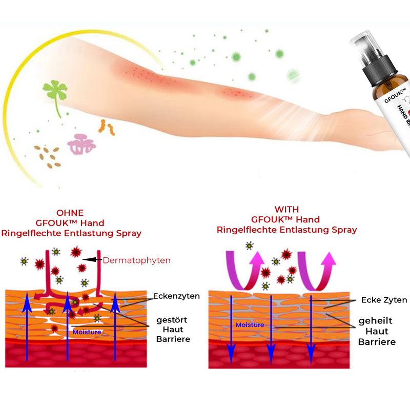 GFOUK™ Hand Ringelflechte Entlastung Spray