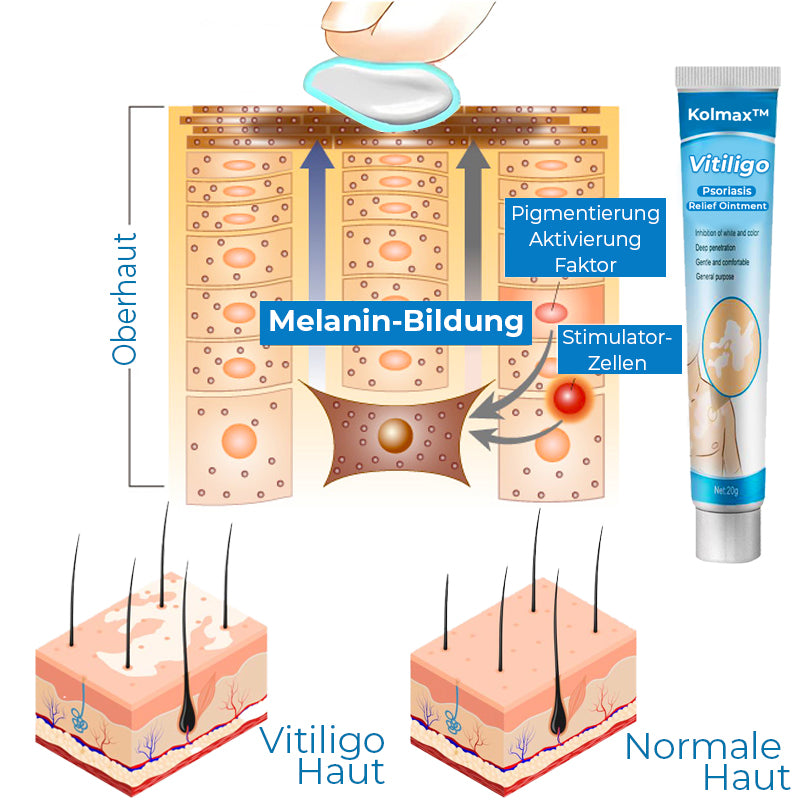 Kolmax™ Vitiligo Linderungssalbe