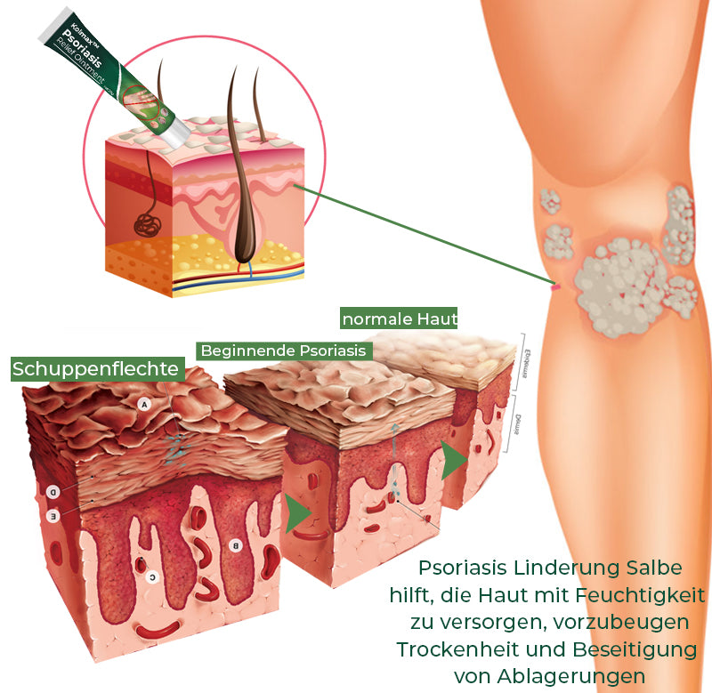 Kolmax™ Psoriasis lindernde Salbe