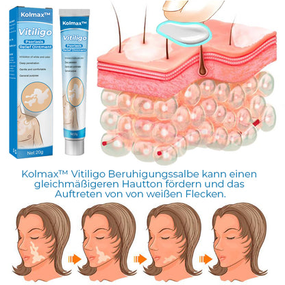 Kolmax™ Vitiligo Linderungssalbe